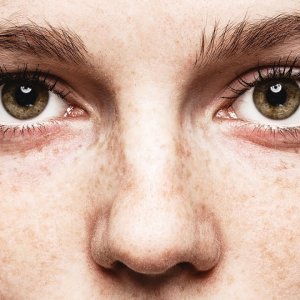 freckles on eyeballs